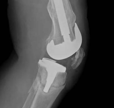 Periprosthetic TKR Tibial Fracture 2